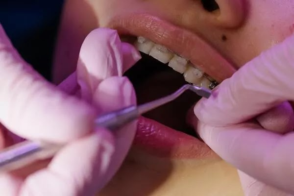 The Dreaded Root Canal | A Dental Procedure