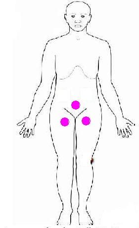 Punctele de acupunctură varicoză, Puncte de acupunctură din varice