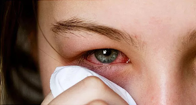 أسباب ألم العين والأعراض والعلاج - ملخص شامل التهاب الملتحمة وألم العين