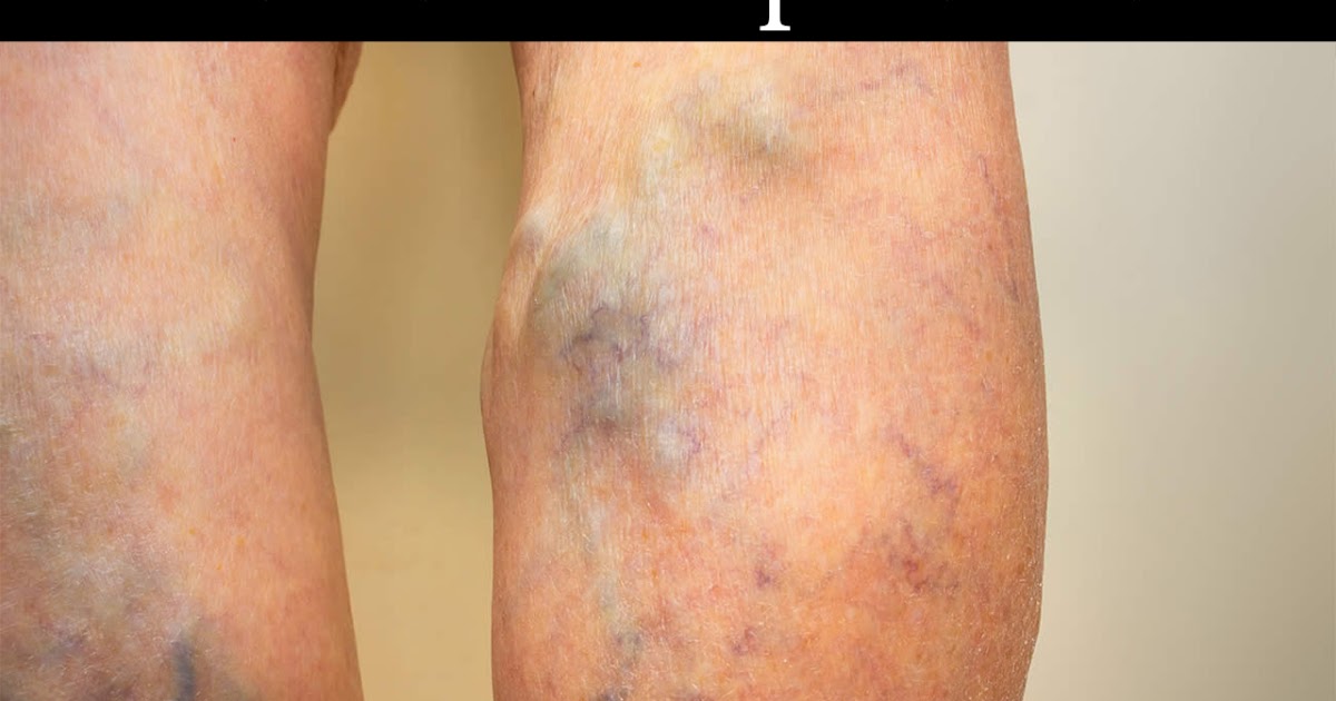 Spider veins causes and methods of treatment