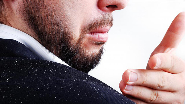 Ini dia, Penyebab dan Faktor Munculnya Ketombe ~ Informasi Kesehatan