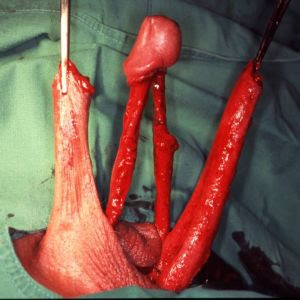 Penile disassembly: corpora cavernosa are completely dissected from urethra, glans and neurovascular bundle