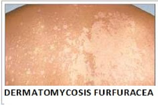 dermatomycosis-www.healthnote25.com