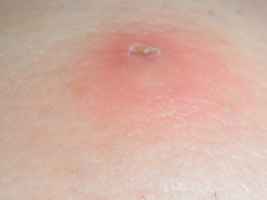 Beleza Pedagógica: Alergia a picada de pernilongo