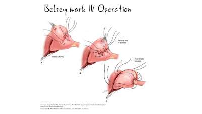 belsey-operation
