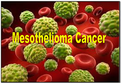Learn how to treat malignant mesothelioma cancer: 