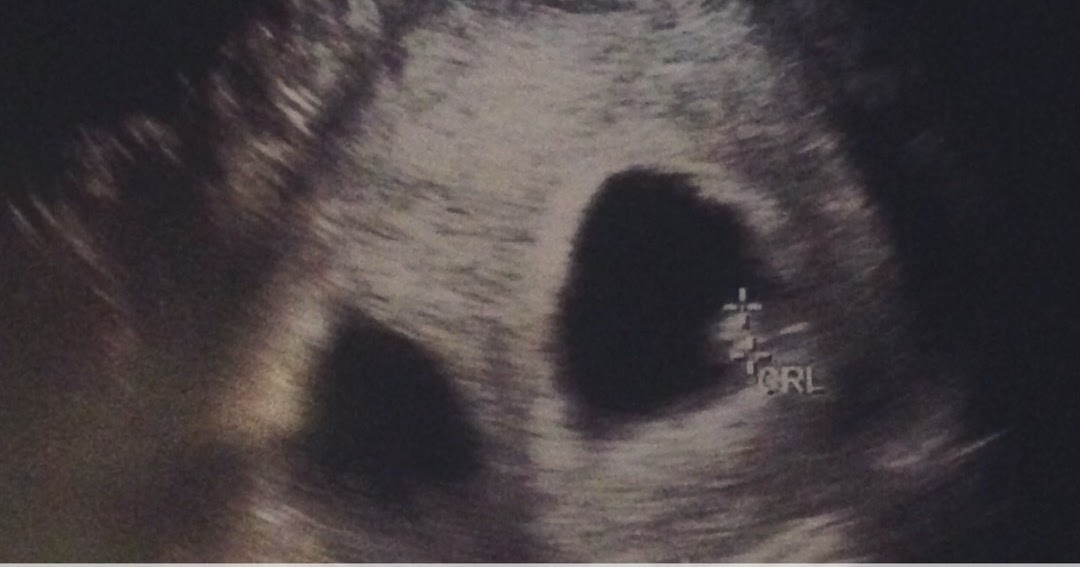 Twin Tips 5 Things To Do When You Find Out You're Pregnant With Twins