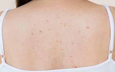 Shoulder Acne : Causes and  How to Get Rid of Shoulder Acne Overnight