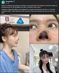Chinese actress Gao Liu shares pictures of her decaying nose as she warns against the dangers of plastic surgery