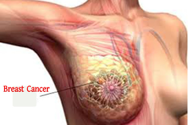Breast Cancer: Causes, Symptoms, Remedies, Prevention and Treatment: