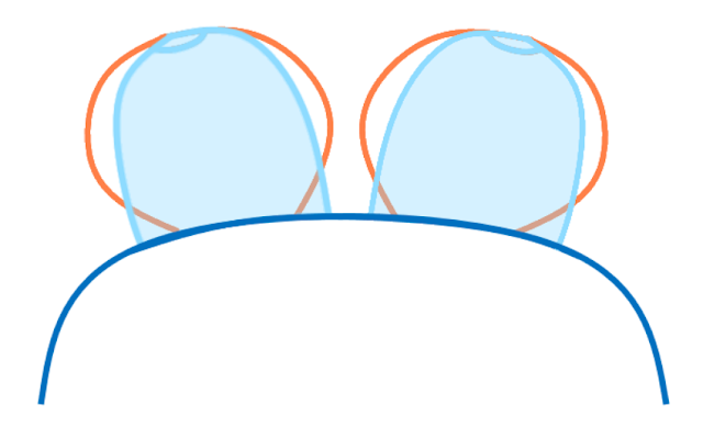 Diagram showing the characteristic round shape of omega breasts vs more cylindrical projected breasts