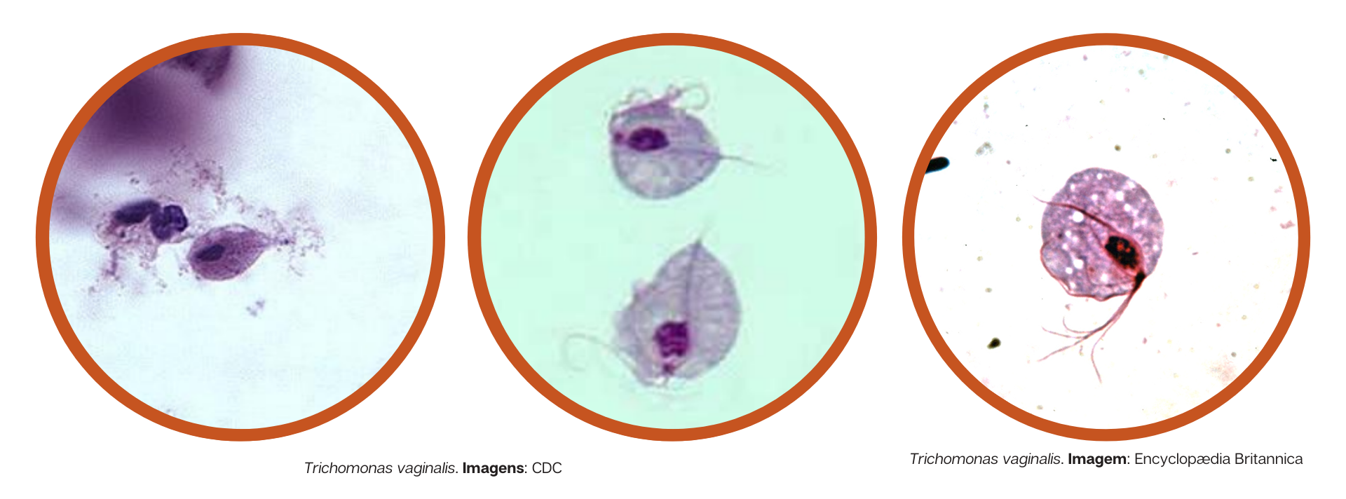 Trichomonas vaginas