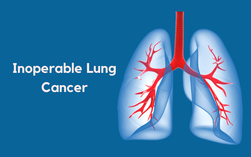 Why Is Small Cell Lung Cancer Inoperable Ikris Pharma Blog: Inoperable Lung Cancer
