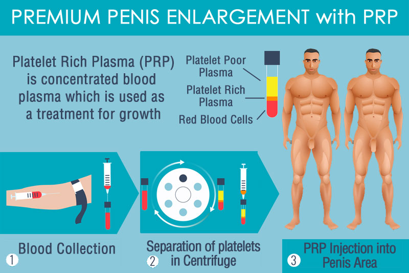 Penis Enlargment Procedure 26