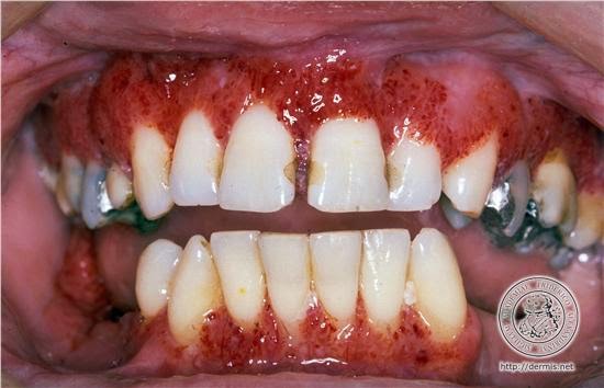 Estomatologia Online: Granulomatose de Wegener