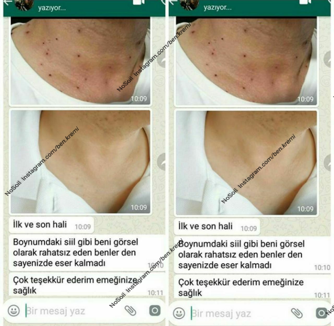 Ürünümüzü kullananlar? Öncesi ve Sonrası Fotoğrafları Bitkisel Ben