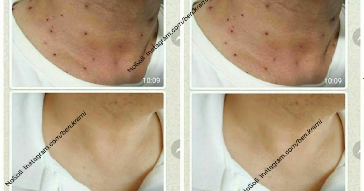 Öncesi/Sonrası Fotoğrafları Bitkisel Ben Silme Kremi Ameliyatsız