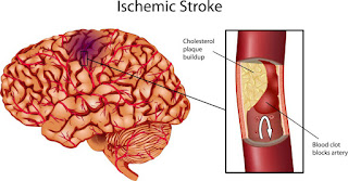 Ischemic Stroke