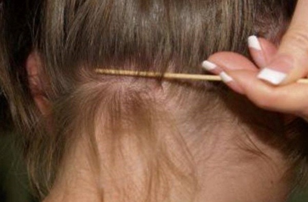 Method of getting rid of lice and infestations permanently