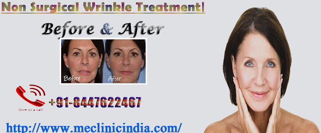 Non Surgical Wrinkle Treatment
