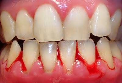 Cách cầm máu khi nhổ răng tại nhà như thế nào là vấn đề mà rất nhiều người thắc máu. Nhổ răng tại nhà thường được các bậc phụ huynh nhổ răng cho trẻ khi trẻ trong giai đoạn thay răng vĩnh viễn. Vậy làm cách nào để cầm máu khi tự nhổ răng tại nhà và có nên tự ý nhổ răng tại nhà hay không? Hãy cùng tìm hiểu qua bài viết dưới đây để hiểu rõ hơn về vấn đề này.    Nguyên nhân gây chảy máu khi nhổ răng    Muốn biết được cách cầm máu khi nhổ răng tại nhà, bạn cần phải biết nguyên nhân gây chảy máu.    Chảy máu khi nhổ răng là do ở vị trí gần chiếc răng bị nhổ, mạch máu niêm mạc bị tổn thương và khi nhổ răng sẽ gây ra chảy máu.    Máu có thể chảy từ màng xương , mạch máu bị đứt cúng là nguyên nhân gây chảy máu.    Đặc biệt, nhổ răng còn sót cũng gây hiện tượng chảy máu. Nhổ răng tại nhà là điều mà các nha sĩ không khuyến khích, vì nó tiềm ẩn những nguy hiểm khó lường.    Chỉ bạn cách cầm máu khi nhổ răng tại nhà hiệu quả nhất    Mặc dù tự ý nhổ răng tại nhà có thể gây ra hậu quả nguy hiểm. Tuy nhiên, nhiều người vẫn thực hiện nhổ răng tại nhà. Trong những trường hợp này, nếu là chảy máu do nhổ răng bình thường thì chỉ cần dùng bông gạc cắn vài phút thì máu sẽ ngưng chảy.    Còn đối với trường hợp máu chảy nhiều và không thể ngưng, bạn cần phải đến ngay các cơ sở nha khao uy tín để được thăm khám và điều trị kịp thời, tránh để xảy ra những hậu quả đáng tiếc.    Việc tự ý nhổ răng tại nhà không an toàn sẽ khiến vi khuẩn xâp nhập, gây đau nhức và viêm sưng. Việc nhổ răng tại nhà không đúng phương pháp sẽ ảnh hưởng rất nhiều đến sức khỏe của bạn và có thể gây nhiễm trùng vết thương.    Cách nhổ răng an toàn và hiệu quả    Như đã chia sẻ ở trên, để đảm bảo sức khỏe của mình cũng như con em. Khi muốn nhổ răng, bạn cần đến các cơ sở nha khoa uy tín để tiến hành nhổ răng.    Một cơ sở nha khoa uy tín phải đảm bảo được các ếu tố như sử dụng công nghệ nha khoa hiện đại, các dụng cụ được khử trùng tuyệt đối, có đội ngũ bác sĩ nhiều năm kinh nghiệm và có nhân viên tư vấn nhiệt tình, thân thiện.    Tại nha khoa Đăng Lưu, các dụng cụ nhổ răng đều được khử trùng và đảm bảo an toàn cho quá trình nhổ răng. Trước khi tiến hành nhổ răng, bác sĩ sẽ tiêm thuốc tê để giảm cảm giác đau, quá trình nhổ răng sẽ diễn ra rất nhanh chóng và an toàn.    Trên đây là những chia sẻ về cách cầm máu khi nhổ răng tại nhà. Tuy nhiên, theo lời khuyên của bác sĩ nha khoa thì bạn không nên tự ý nhổ răng tại nhà vì có thể gây ra những biến chứng ngy hiểm nếu nhổ răng không đúng phương pháp.    Bài viết trích nguồn tại: https://niengrangmaccaisudangluu.blogspot.com  Thông tin liên hệ:  Trung tâm nha khoa Đăng Lưu  Địa chỉ:  Cơ sở 1: 34 Phan Đăng Lưu, P.6, Q.Bình Thạnh –(+84 8) 6297 7148  Cơ sở 2: 540 Trần Hưng Đạo, P.2, Q.5 –(+84 8) 6682 0346  Hotline:  (+84 8) 66820346  Tg: Ngavvt