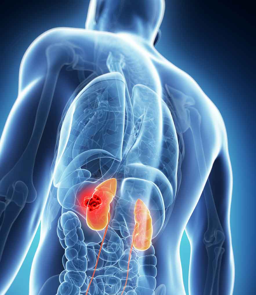 14 MAJOR SYMPTOMS OF KIDNEY DISEASE THAT CAN LEAD TO DEATH IF IGNORED