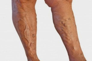 venituri varicoase de manifestare great saphenous vein removal