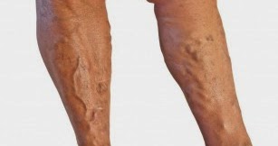 reete populare pentru picioarele varicoase
