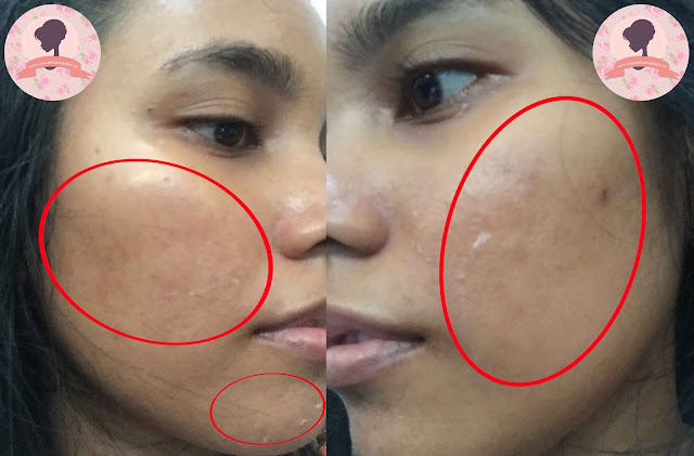 Hasil-micro-laser-PPP-Laser-Clinic