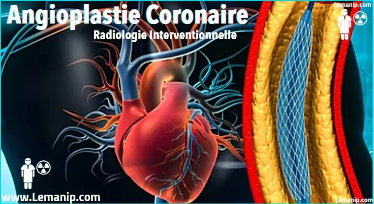 Angioplastie Coronaire Radiologie Interventionnelle