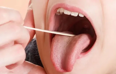 Tonsil abscess