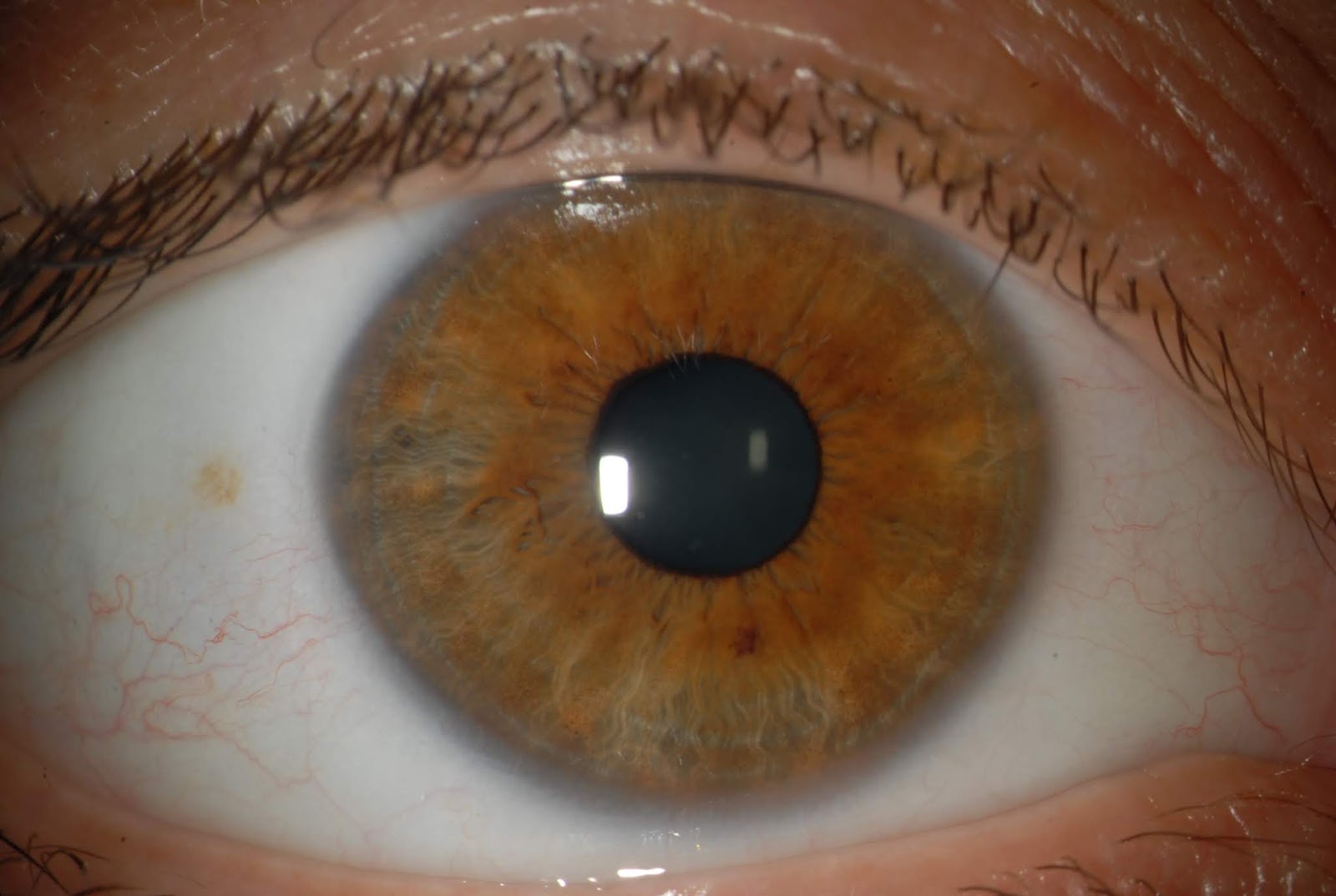 The story of my eye Before [cataract surgery] photos