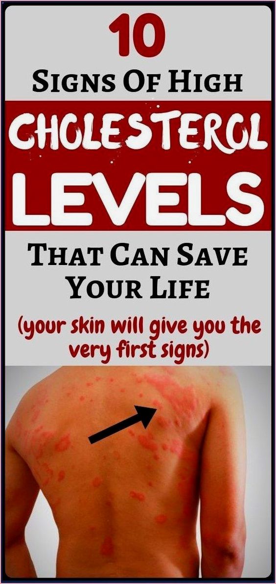 10 Symptoms of High Cholesterol That You Shouldn’t Ignore wellness days