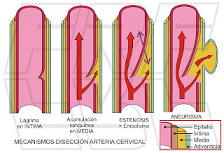 Mecanismos disección arteria vertebral.