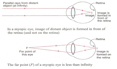 Human Eye defe4 - मानव नेत्र और उसके दोष