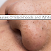 8 Main Causes Of Blackheads And Whiteheads On The Nose Area You Should Know