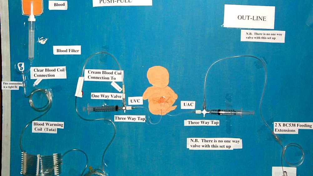 Exchange Transfusion exchange-transfusion