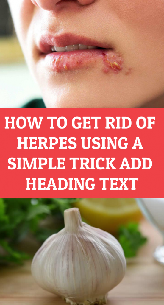 Get Rid Of Herpes Using A Simple Trick - Healthy Zone