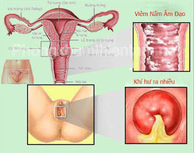 Hình ảnh viêm cổ tử cung