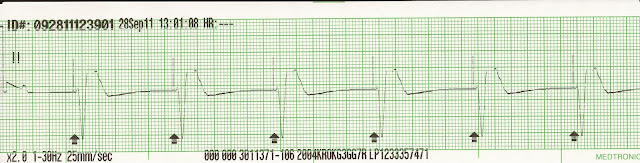 EKG Rhythm Strips 22: Paced Rhythms