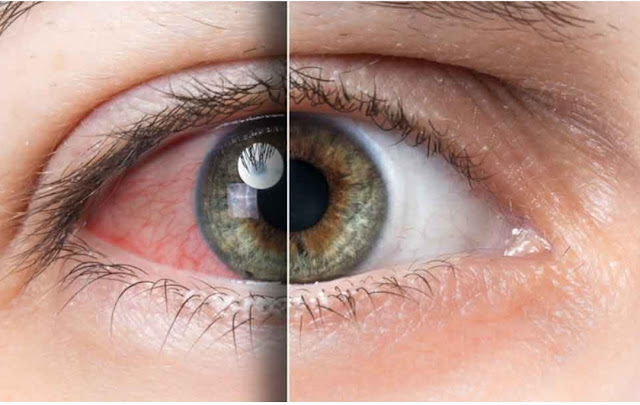 Pendarahan Di Hidung