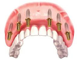 Trồng răng implant có đau không?