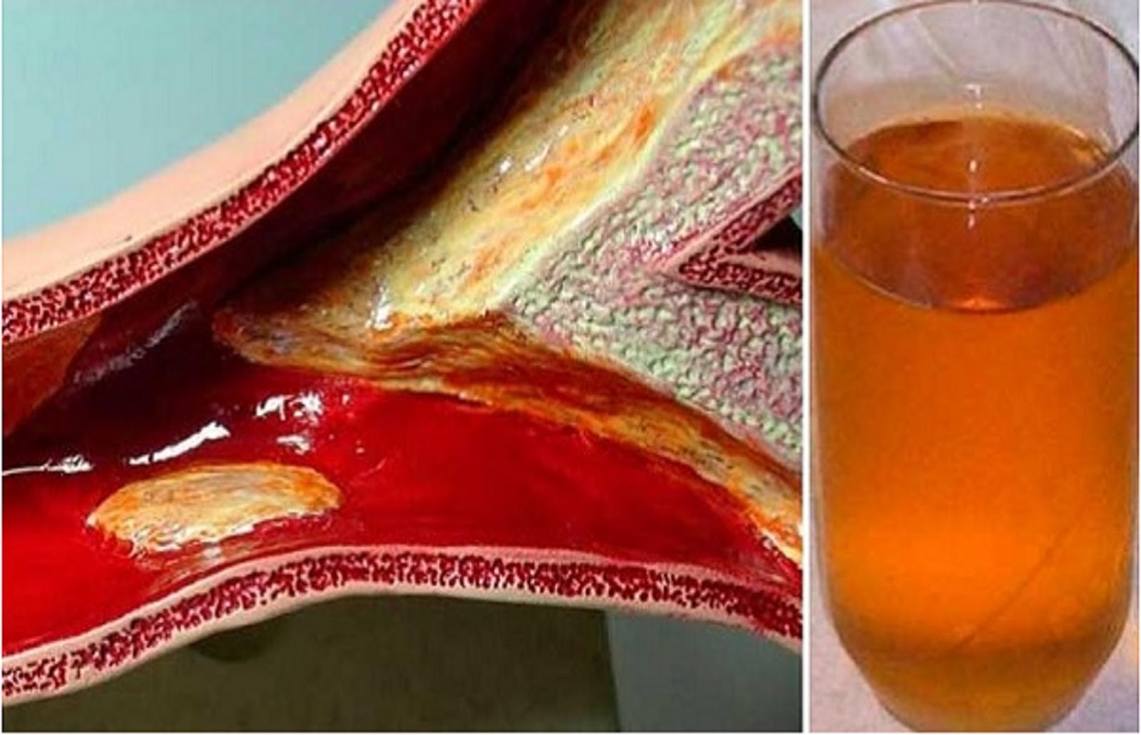 Natural Remedies For Heart Blockage Natural Remedies For Heart Blockage