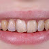 Tẩy trắng răng cho răng vàng ố