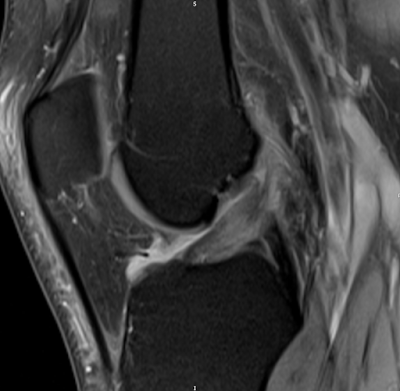 High-grade anterior cruciate ligament tear