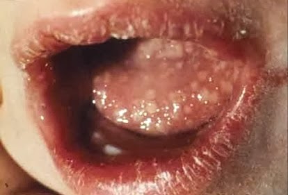 Penyakit Herpes Pada Mulut