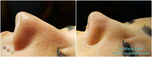 Nose Tip Plasty in Istanbul, Natural Nose Tip Aesthetic Surgery in Female