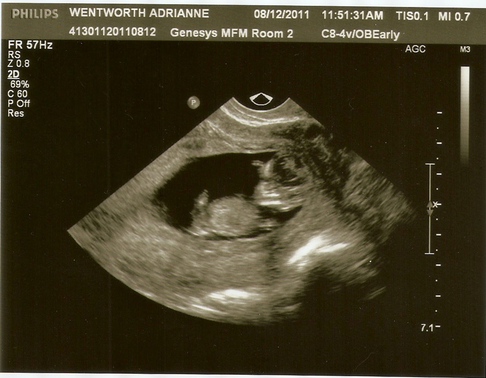 Me &amp; Sweet Peas Ultrasound pics 10 weeks 1 day