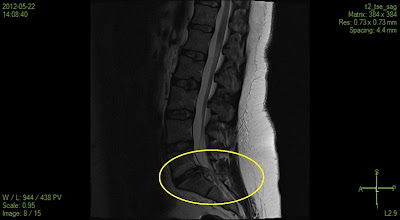 MRI scan showing a huge prolapsed disc