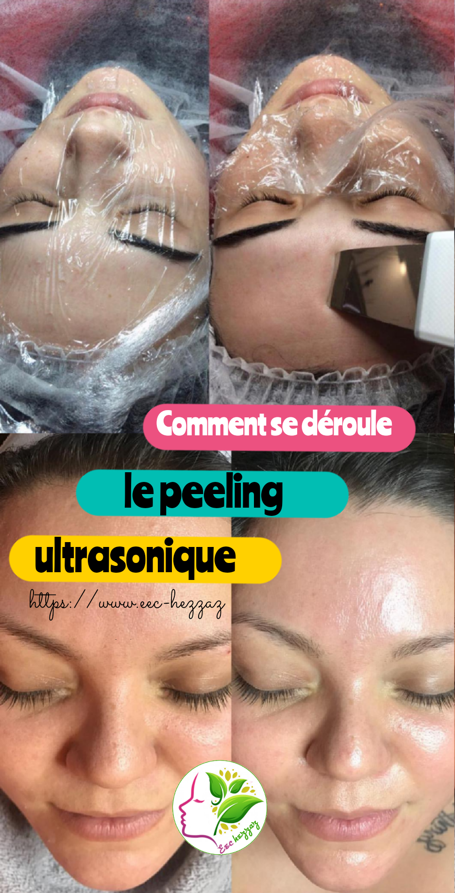 Comment se déroule le peeling ultrasonique